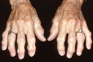Hand OA